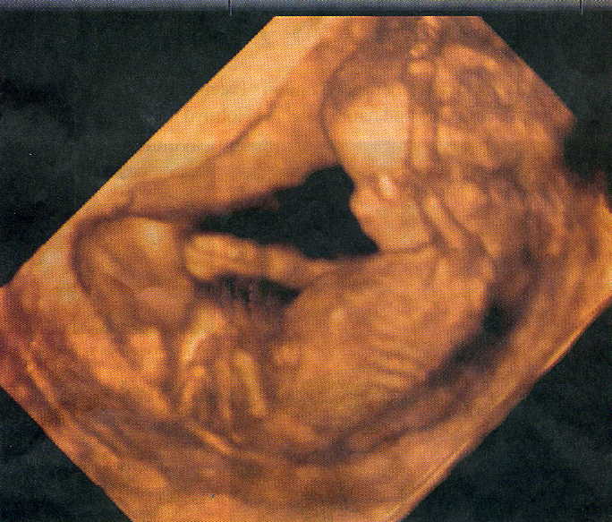 Unborn Ultra